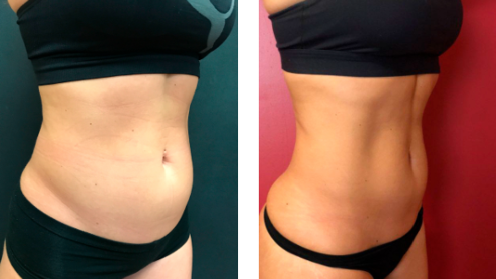 emsculpt_before_and_after_photo.png emsculpt_before_and_after_photo.png