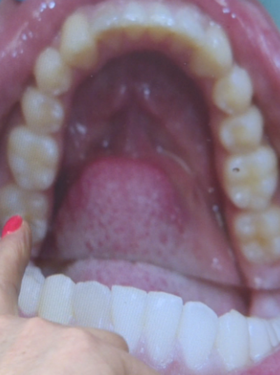 teeth from pacifier use